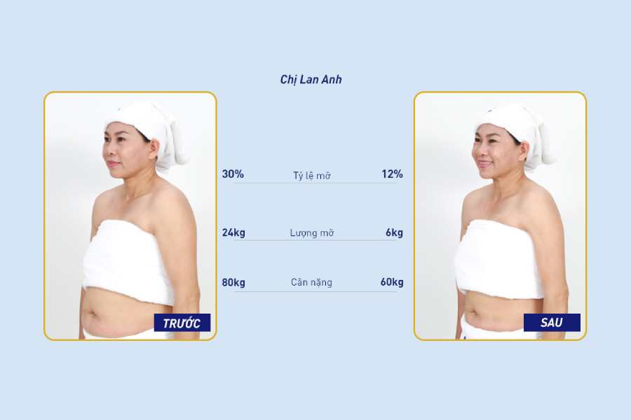 Kết quả giảm mỡ tại Thẩm mỹ viện Ngọc Dung